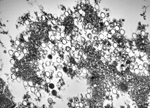 cytomegalovirus - pneumonia cytomegalovirus - pneumonia